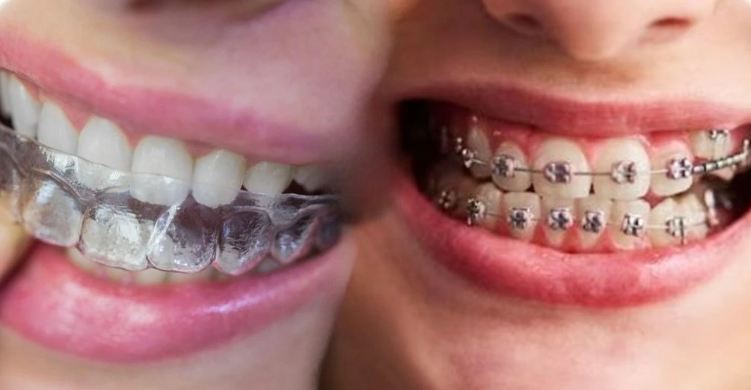 invisalign-vs-braces-pros-and-cons-vitrin-clinic